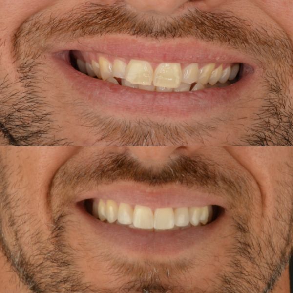 Antes y después de llevar alineadores invisibles