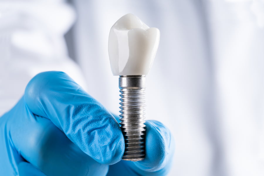 Mejores materiales para implantes dentales