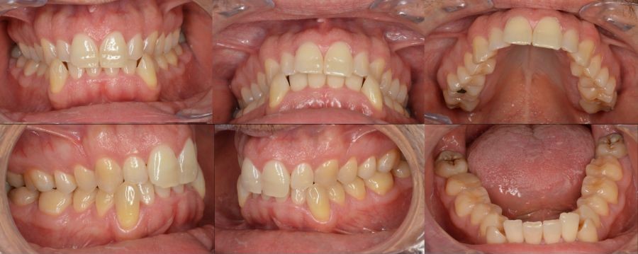 Mordida cruzada y dientes apiñados