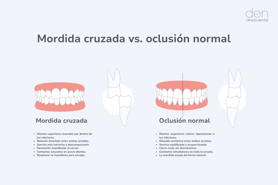 Diferencias entre mordida cruzada y oclusión normal