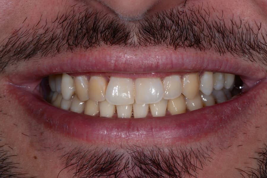 antes blanqueamiento dental servicio