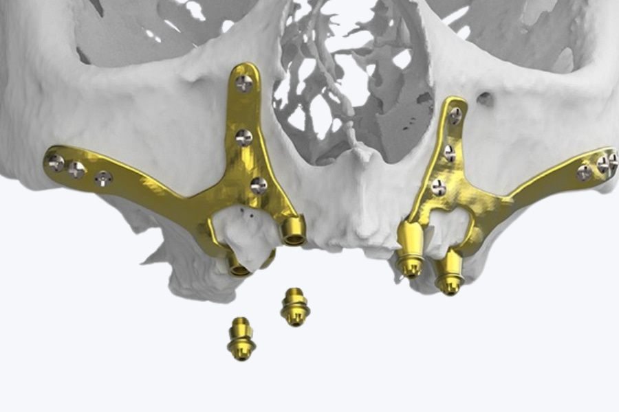 qué son los implantes subperiósticos