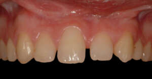 Agenesia dental