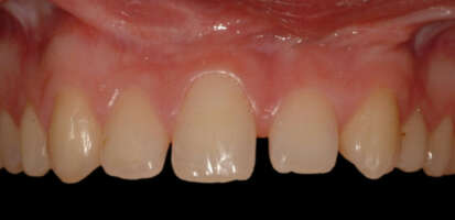 Agenesia dental
