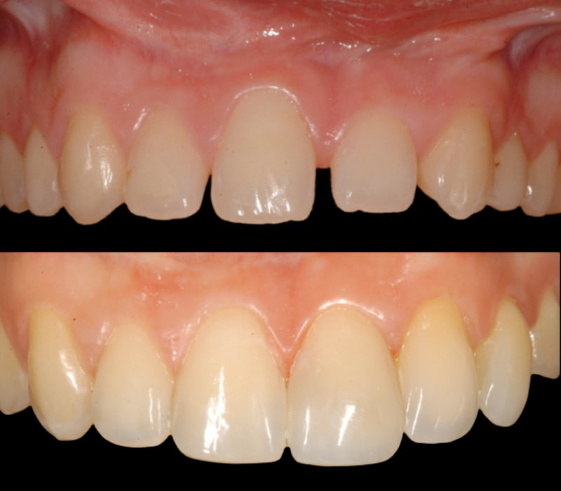 Agenesia dental antes y después