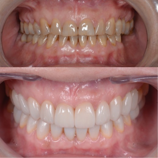 Carillas, fundas e implantes dentales en Barcelona