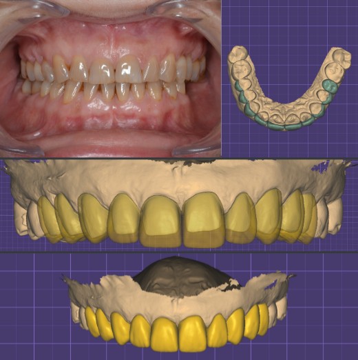 Diseño digital de sonrisa para implantes dentales