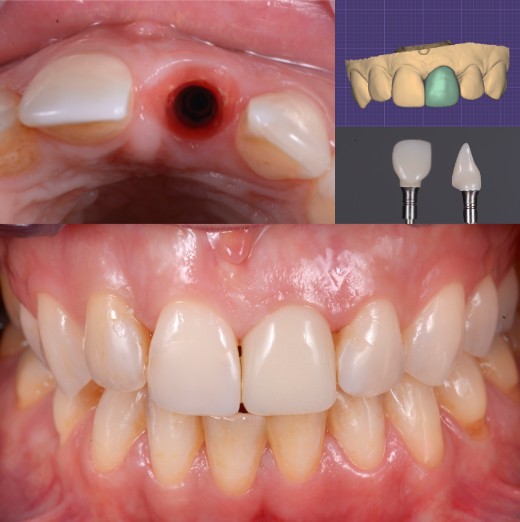 Implante dental para rehabilitación oral