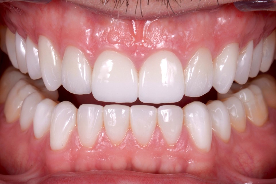 Implantes Dentales en Barcelona