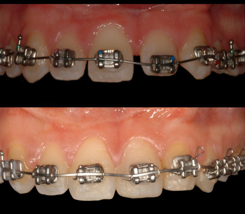 Ortodoncia de Brackets para tratar agenesia dental