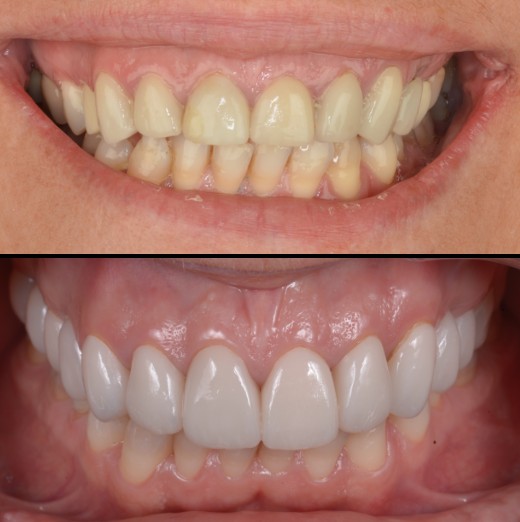 Puentes y prótesis dentales en Barcelona