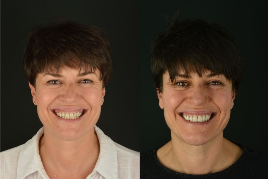 Antes y después de una restauración oral completa