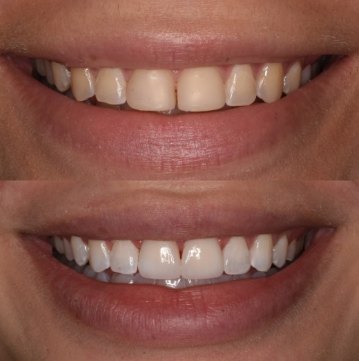 Carillas y blanqueamiento dental Barcelona