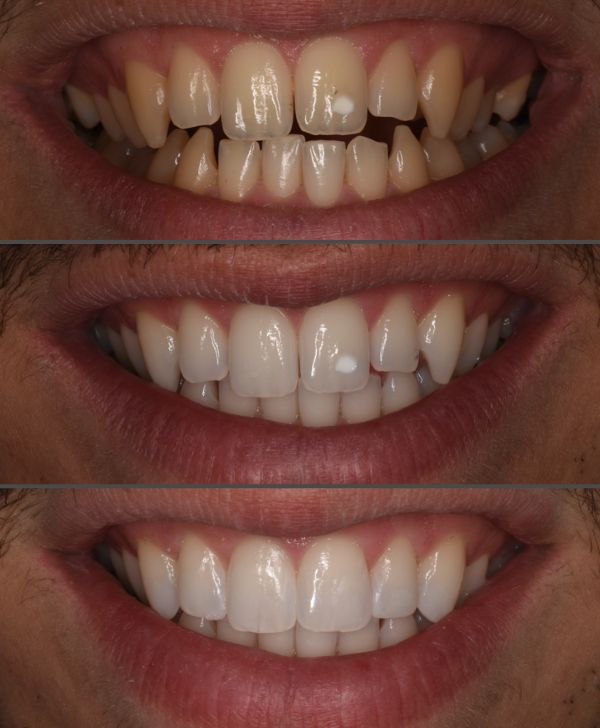 Blanqueamiento y carillas dentales en Barcelona