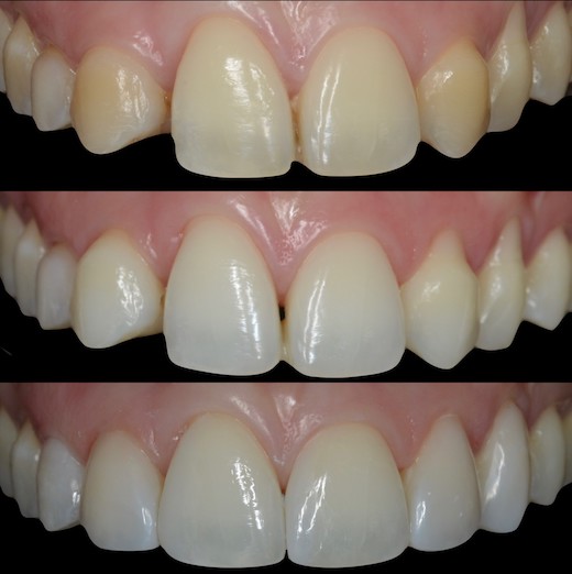 Blanqueamiento y carillas en dientes anteriores
