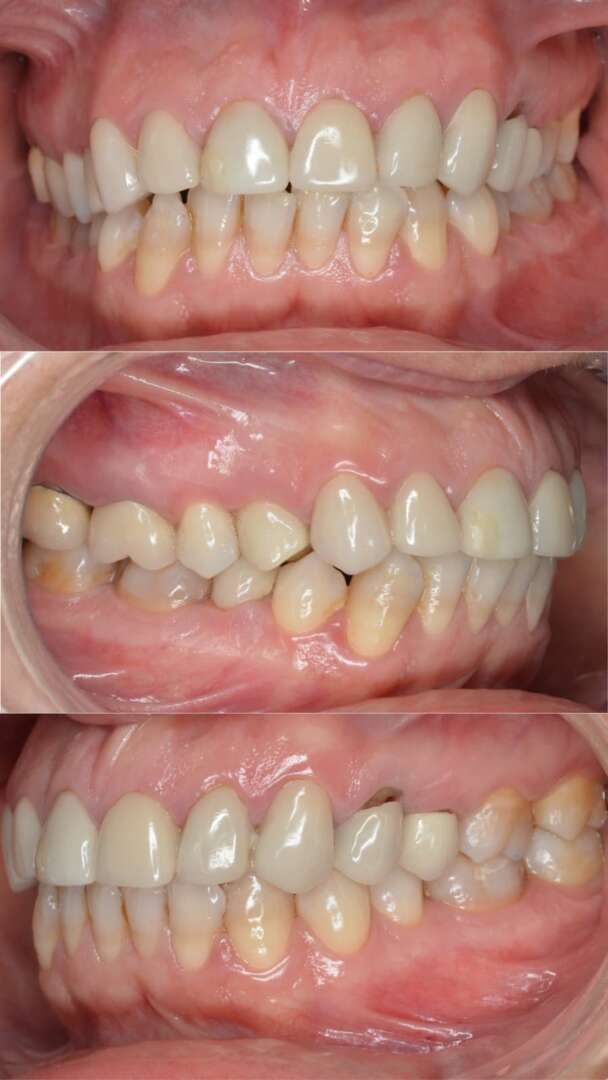 Boca con dolor muscular, problemas de ATM, desgaste y manchas dentales