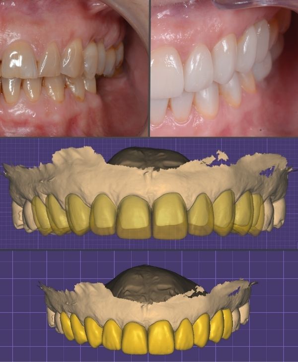 Diseño digital de sonrisa para implantes dentales