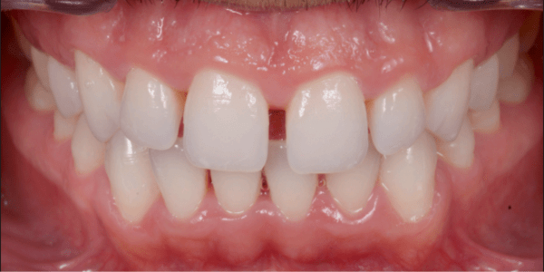 Carillas cerámicas para cerrar diastema antes