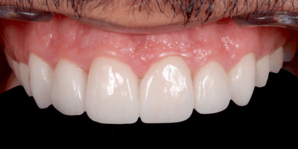 Carillas cerámicas cerrar para diastema después
