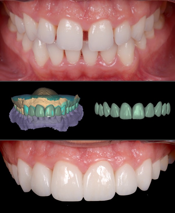 Carillas dentales para corregir diastema