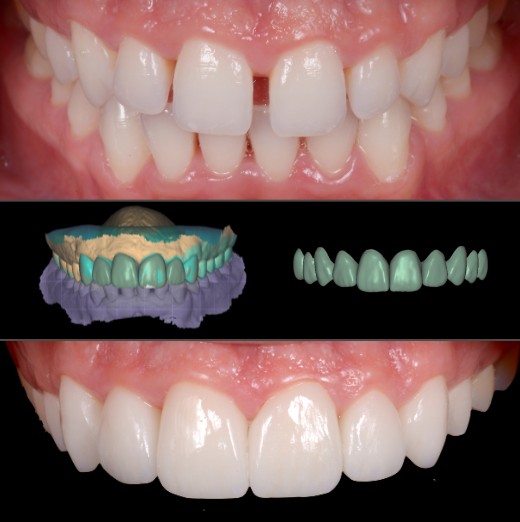 Carillas dentales para corregir diastema