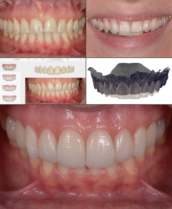 Reconstrucción estética con fundas y carillas dentales en Barcelona