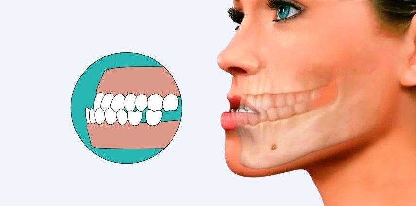 Causas prognatismo mandibular 