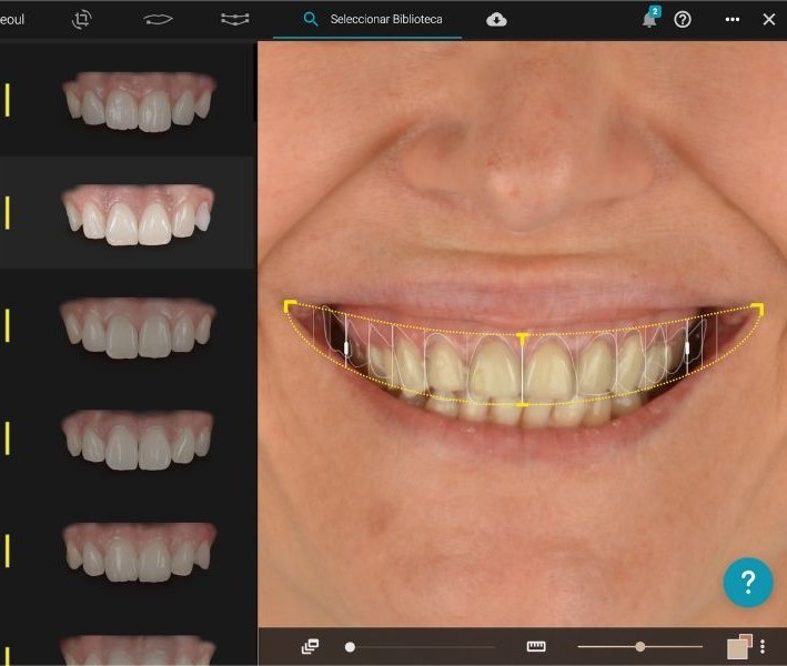 Diseño digital de la sonrisa - Tecnología dental