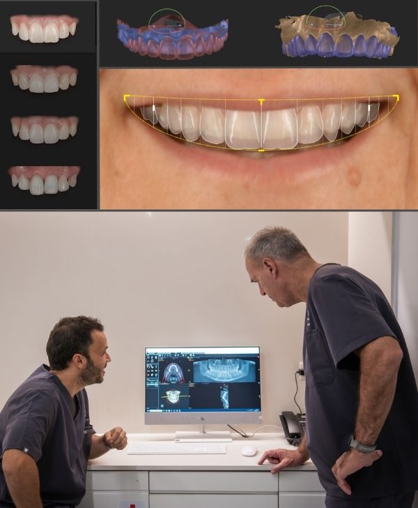 Diseño digital de la sonrisa para implantes dentales