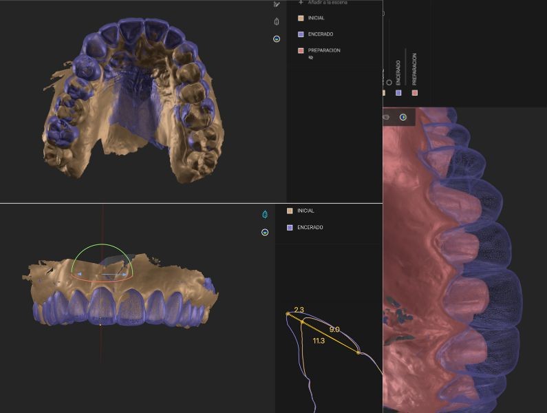 Diseño digital en restauración dental 