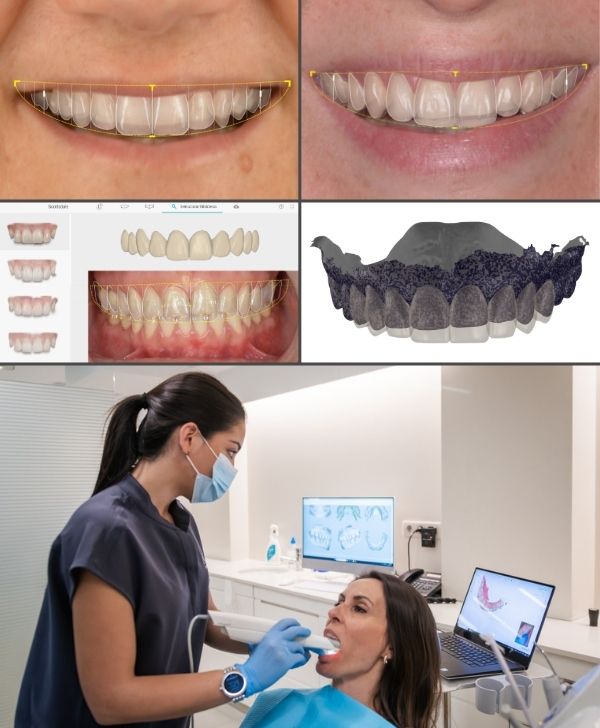 Diseño digital de sonrisa para estética dental en Barcelona