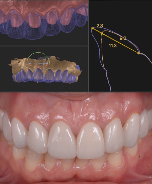 Prótesis y puentes dentales en Barcelona
