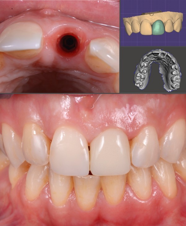 Implante dental para rehabilitación oral en Barcelona