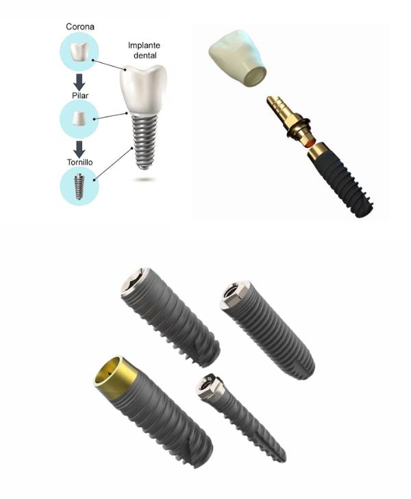 Partes de un implante dental