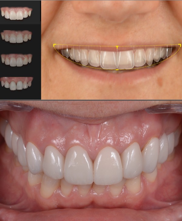 Puentes y fundas dentales en Barcelona