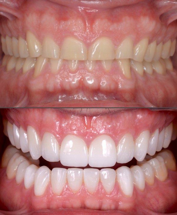 Reconstrucción estética con fundas y carillas en Barcelona