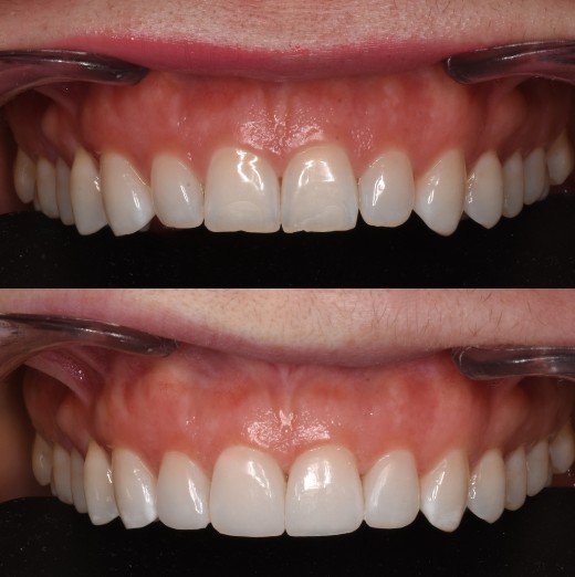 Reconstrucción estética con carillas dentales