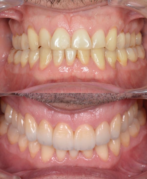 rehabilitar estabilizar mandibula