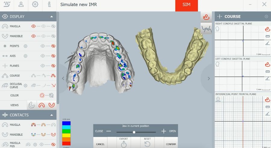 Software de análisis oclusal digital 