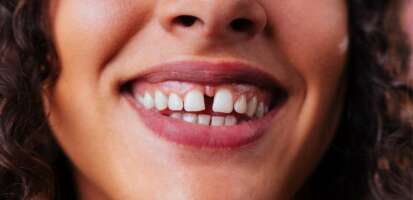 Diastema dental antes y después ¡Casos reales de Clínicas Den!