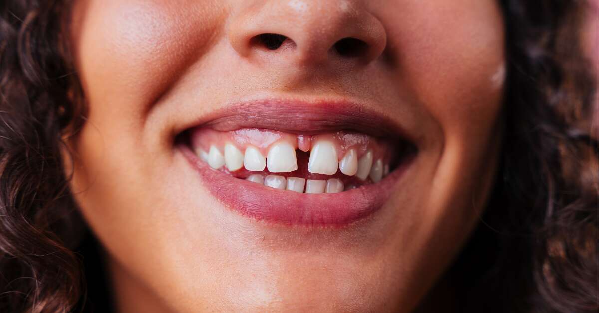 Clínicas Den - Diastema dental antes y después ¡Casos reales de Clínicas Den!