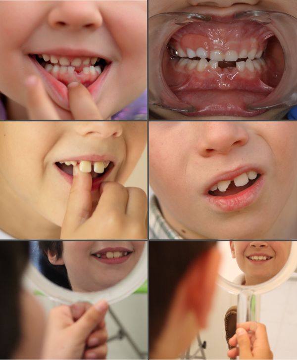 Odontología pediátrica en Barcelona