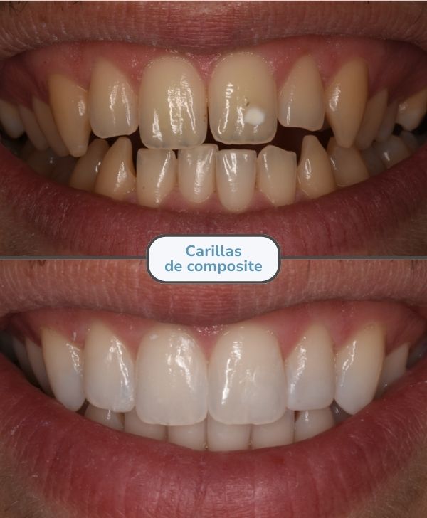 Carillas dentales de composite en Barcelona