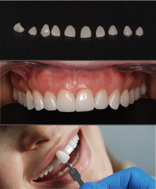 Tu clínica de carillas dentales en Barcelona