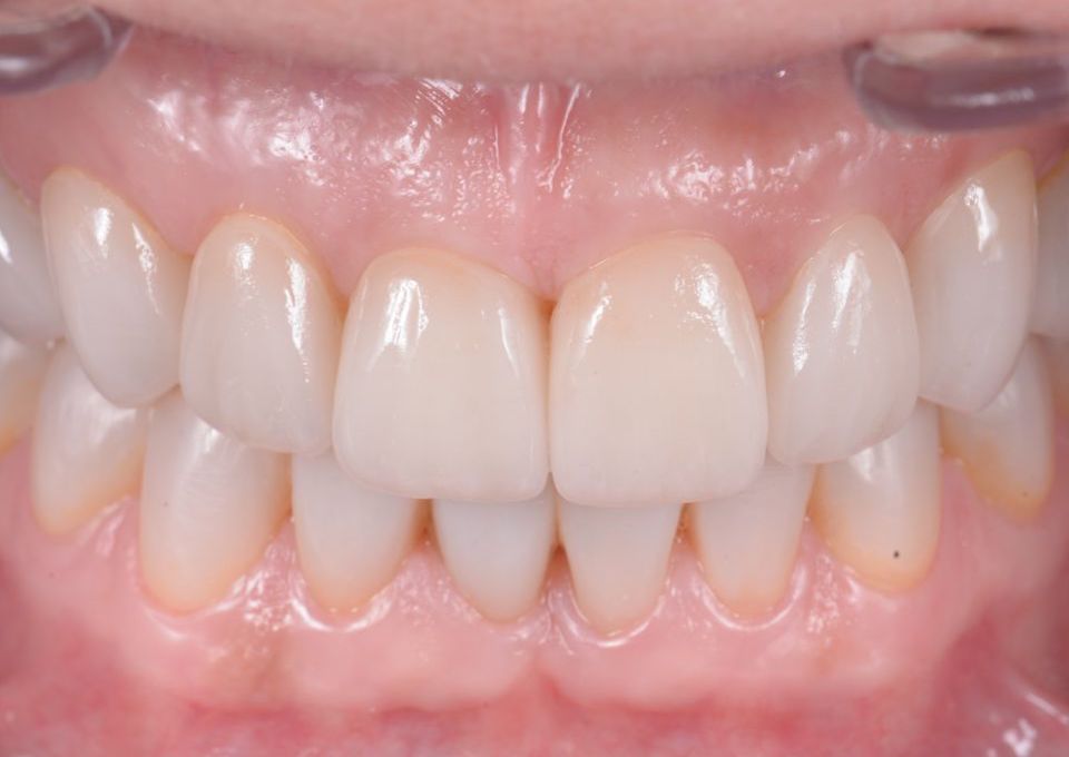 Carillas dentales en Barcelona