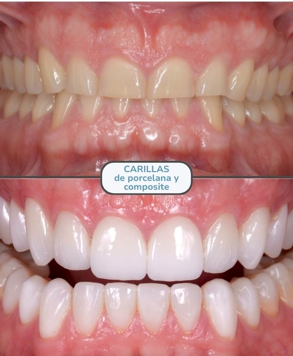 Carillas dentales en Barcelona (Porcelana y composite)