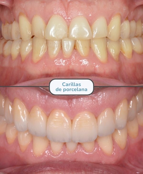 Carillas dentales de porcelana en Barcelona