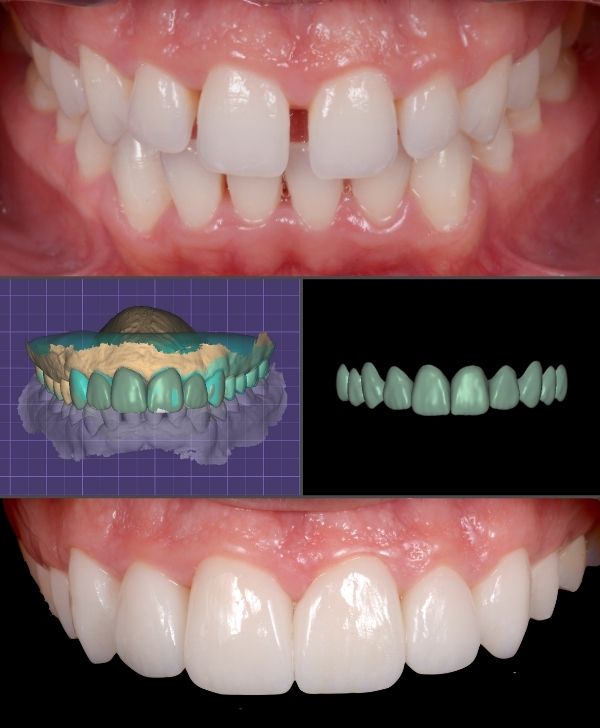 Tratamiento de carillas dentales diseñado a tu medida