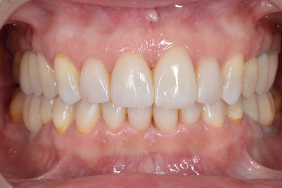Tratamiento de bruxismo en cara y dolor mandibular
