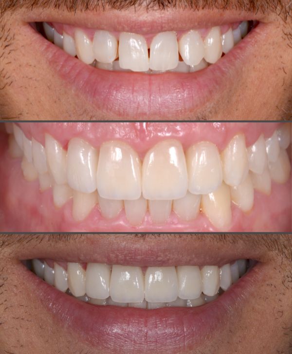 Tu clínica de carillas dentales en Barcelona